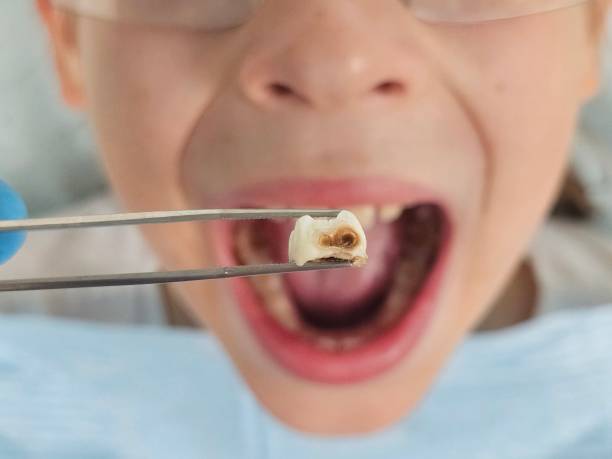 Best Emergency Treatment for Dental Infections or Abscesses in Morongo Valley, CA